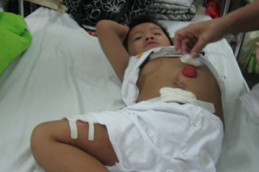 Chuyển hậu môn tạm về vị trí tự nhiên cho Thiên Bảo