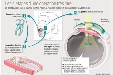 “Xóa” mù nhờ cấy răng vào mắt