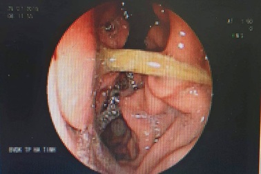 Người đàn ông bị thủng dạ dày vì ngậm tăm ngủ sau khi ăn