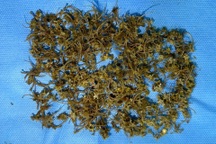 Người phụ nữ phải cấp cứu do nuốt hàng nghìn mảnh xương rắn