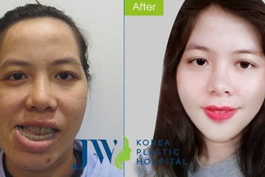 Cô giáo mặt méo ‘lột xác’ ngoạn mục sau phẫu thuật thẩm mỹ