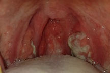 TPHCM: Nam thanh niên bị bạch hầu, cách ly 16 người tiếp xúc