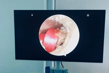Vừa nghỉ hè, bé gái đã suýt thủng màng nhĩ vì... dây buộc tóc