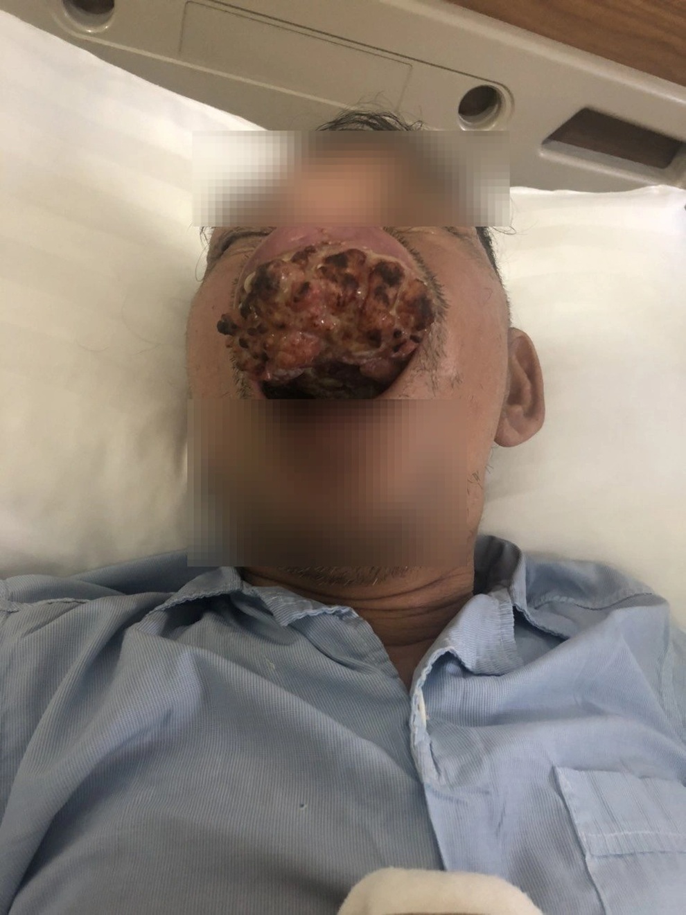 Hà Nội: Sốc với khối ung thư kín miệng bệnh nhân phải hoãn điều trị vì dịch - 1 Hà Nội: Sốc với khối ung thư kín miệng bệnh nhân phải hoãn điều trị vì dịch - 1