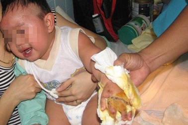 Nối thành công bàn tay đứt lìa cho bệnh nhi 14 tháng tuổi