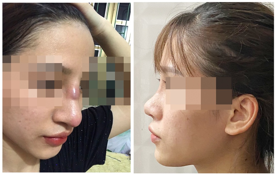 Nữ sinh 19 tuổi suýt thủng mũi sau khi làm đẹp tại spa - 1