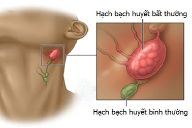 Nguyên nhân gây sưng hạch ở trẻ em