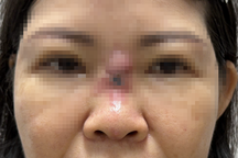 Thầy phán "mũi thấp, vận nghèo" rồi... sửa mũi cho khách, gây tai biến nặng