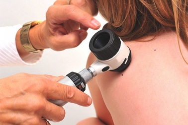 Bạn có nguy cơ mắc loại ung thư da nào?