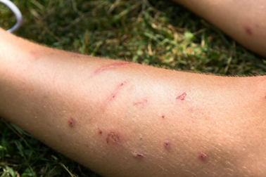 Tại sao người này bị muỗi cắn nhiều hơn người kia?