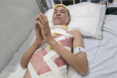 Đa chấn thương, nguy kịch vì bỏng điện, người bố 2 con cầu xin sự sống