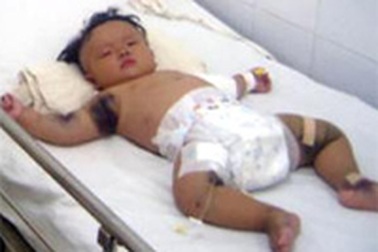 Cứu sống 2 trẻ nhũ nhi bị SXH nặng