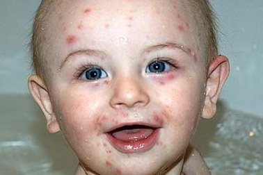 Ánh nắng mặt trời giúp hạn chế thủy đậu lây lan