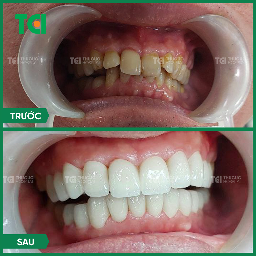 Giải pháp cho răng nhiễm Tetracycline - 3