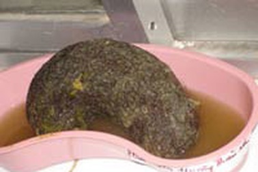 Phẫu thuật lấy búi tóc 350g trong dạ dày bệnh nhi 8 tuổi