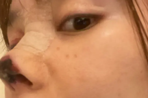 Người đẹp Trung Quốc mũi hoại tử đen sì sau phẫu thuật thẩm mỹ hỏng