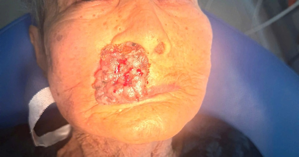 Từ nốt ruồi nhỏ trên mặt, sau 3 năm phát triển thành khối u, giòi làm tổ