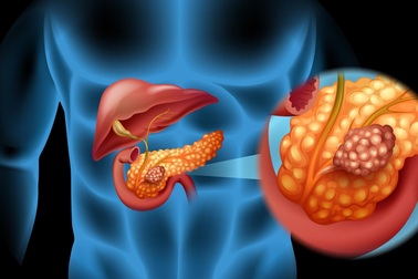 Thuốc trị sỏi thận thế hệ mới có thể khiến ung thư “chết đói”