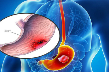 Bình Vị An - Giải pháp hỗ trợ giảm triệu chứng đau dạ dày
