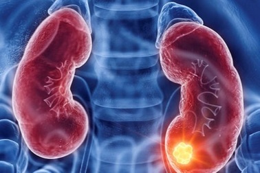 Những người nào dễ mắc ung thư thận?