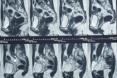 15 năm rong kinh, đau vùng chậu vì lạc nội mạc tử cung