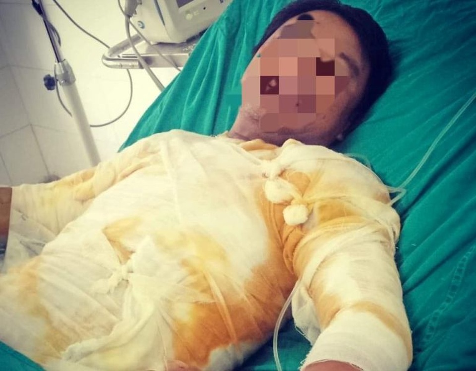 Xử lý sự cố gây mất điện, nhân viên điện lực bị điện phóng gây bỏng nặng - 1 Xử lý sự cố gây mất điện, nhân viên điện lực bị điện phóng gây bỏng nặng - 1