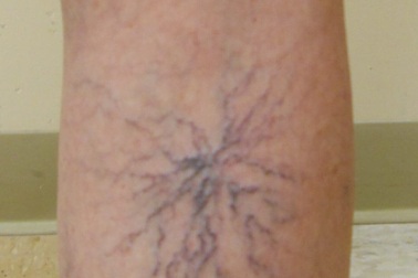 Suy tĩnh mạch làm giảm chất lượng cuộc sống của phụ nữ