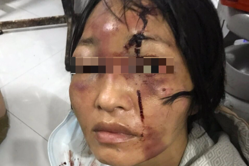 Người phụ nữ ôm con gái đầy thương tích, giữa đêm chạy trốn gã chồng hờ - 1 Người phụ nữ ôm con gái đầy thương tích, giữa đêm chạy trốn gã chồng hờ - 1