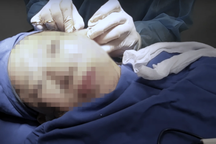 TPHCM: Người phụ nữ 70 tuổi ngưng thở sau mổ căng da ở bệnh viện thẩm mỹ