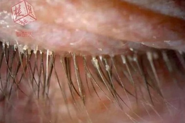 Kinh hoàng rận bu kín lông mi vì 5 năm không giặt vỏ gối