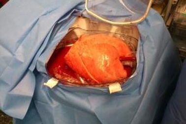 Lá phổi chờ ghép được bảo tồn lâu nhất từ trước tới nay