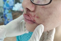 Cô gái trẻ tan nát khuôn mặt sau tiêm filler làm đẹp