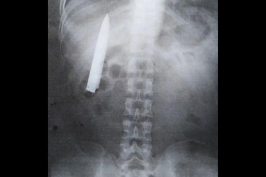 Dao găm trong ngực hơn 1 năm mà không biết