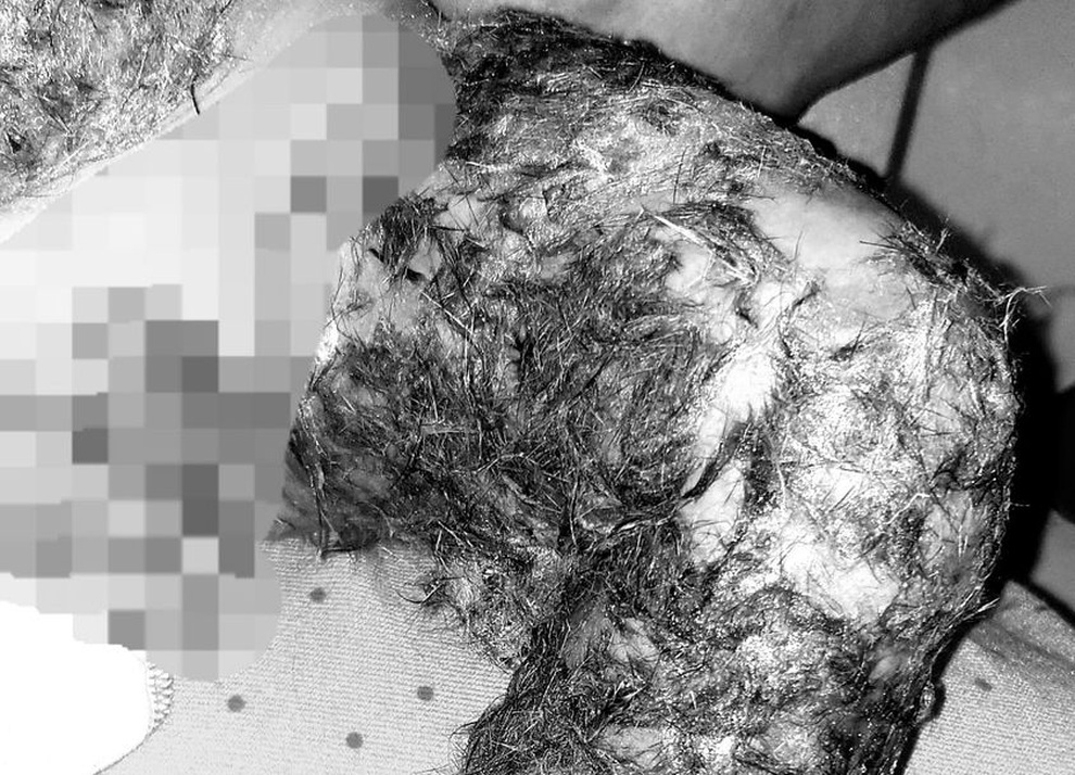 Rợn người với những cách chữa bỏng truyền miệng - 1 Rợn người với những cách chữa bỏng truyền miệng - 1