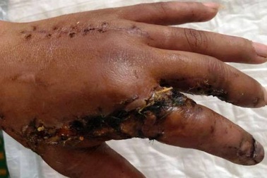 Nối thành công 2 ngón tay bị máy cưa cắt lìa cho bệnh nhân