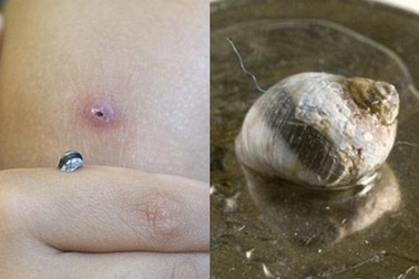 Thất kinh ốc sên sống trong...khối cục sưng tấy ở đầu gối