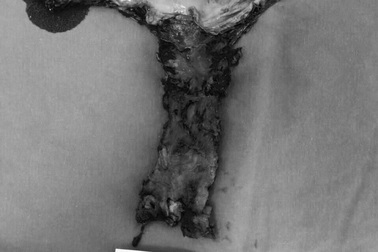 Lần đầu nội soi cắt toàn bộ âm đạo, cứu sống nữ bệnh nhân ung thư