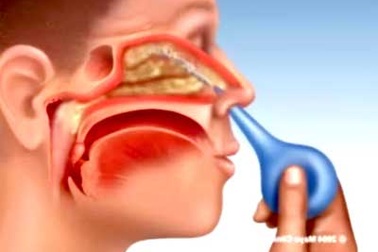 Viêm tai, viêm họng vì xịt rửa mũi không đúng cách