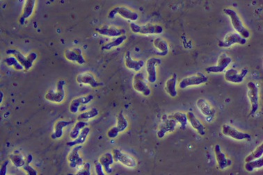 Nguyên nhân và triệu chứng khi bị nhiễm vi khuẩn amip ăn não