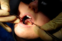 Lười đánh răng, coi chừng nguy cơ ung thư miệng và dạ dày