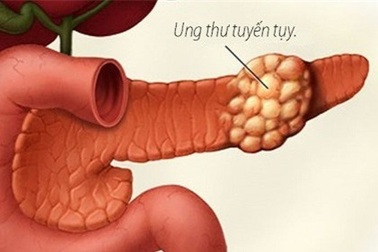 Bạn sẽ có những biểu hiện này khi ung thư tụy tiến triển
