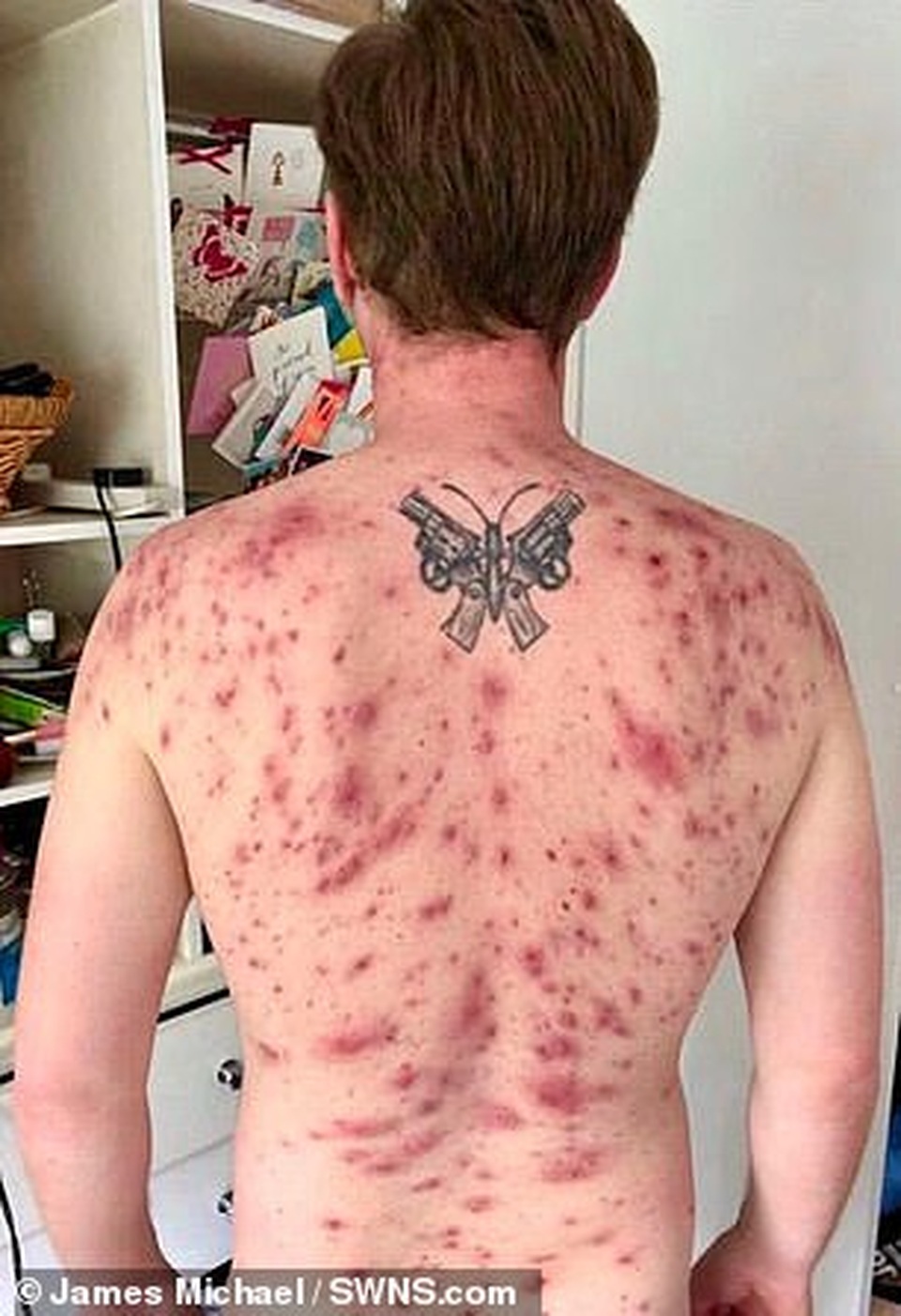 Khách nam bị ký sinh trùng chui vào “chỗ hiểm” và đẻ trứng - 3 Khách nam bị ký sinh trùng chui vào “chỗ hiểm” và đẻ trứng - 3