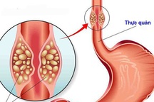 Từ bỏ hai thứ gây nghiện này để không lo ung thư thực quản