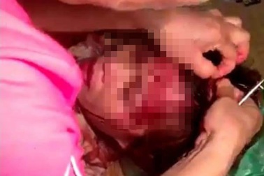 Điều tra nghi án “bồ” của chồng tấn công vợ gây thương tích nặng