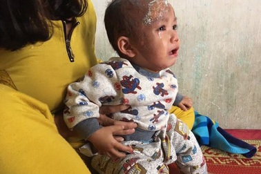 Xót xa bé 17 tháng bỏng nửa khuôn mặt do nước sôi