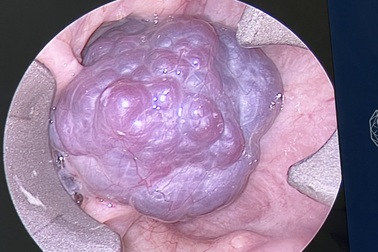 Căn bệnh khiến người phụ nữ Campuchia phải sang Việt Nam chữa trị