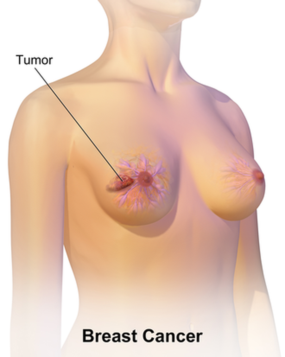 3. Triệu Chứng Của Ung Thư Hạch Nách