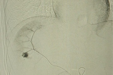 Nút động mạch cầm máu, cứu nam thanh niên bị vỡ nát gan