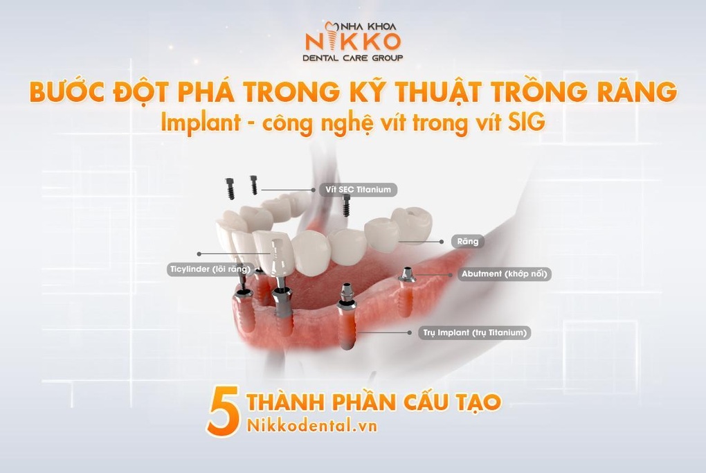 Những rủi ro khi cấy ghép implant giá rẻ - 3 Những rủi ro khi cấy ghép implant giá rẻ - 3