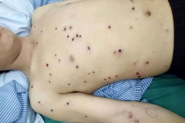 Người đàn ông đi kéo gỗ bị đạn hoa cải găm chi chít trên người